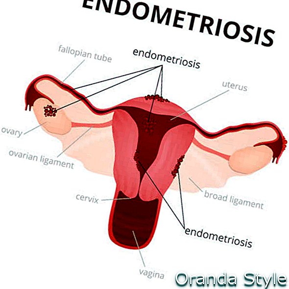 Az endometriózis