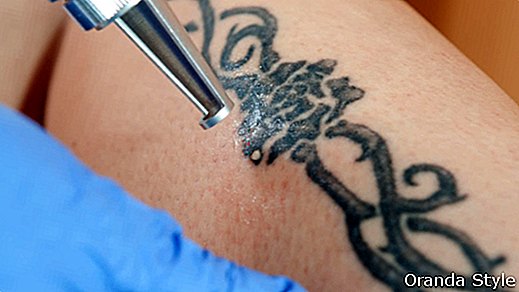 Tatuoinnin poistomenetelmät - kaikki mitä sinun tarvitsee tietää