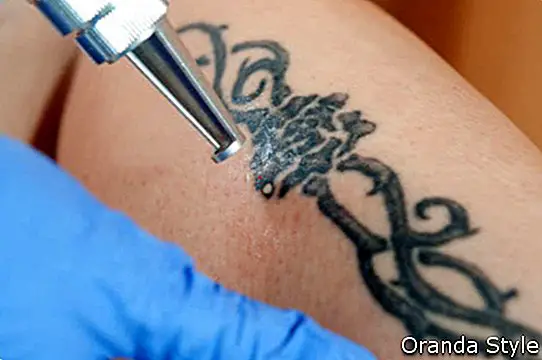 laser - tatuoinnin poistomenetelmät