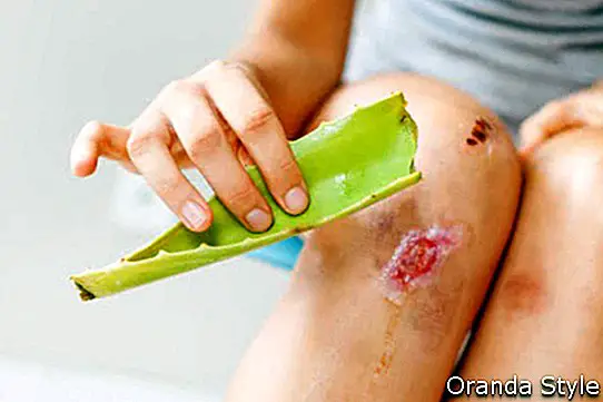 kvinne desinfiserer såret sitt med aloe vera