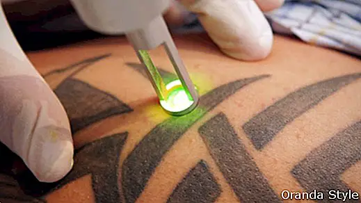Laser Tattooentfernung