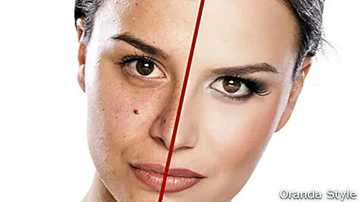 Cómo deshacerse de las cicatrices del acné
