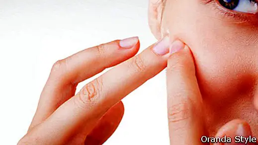 7 Home Remedies, die helfen, Akne zu beseitigen