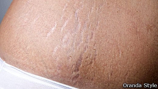 Hur man tar bort stretch Marks - The Ultimate Guide